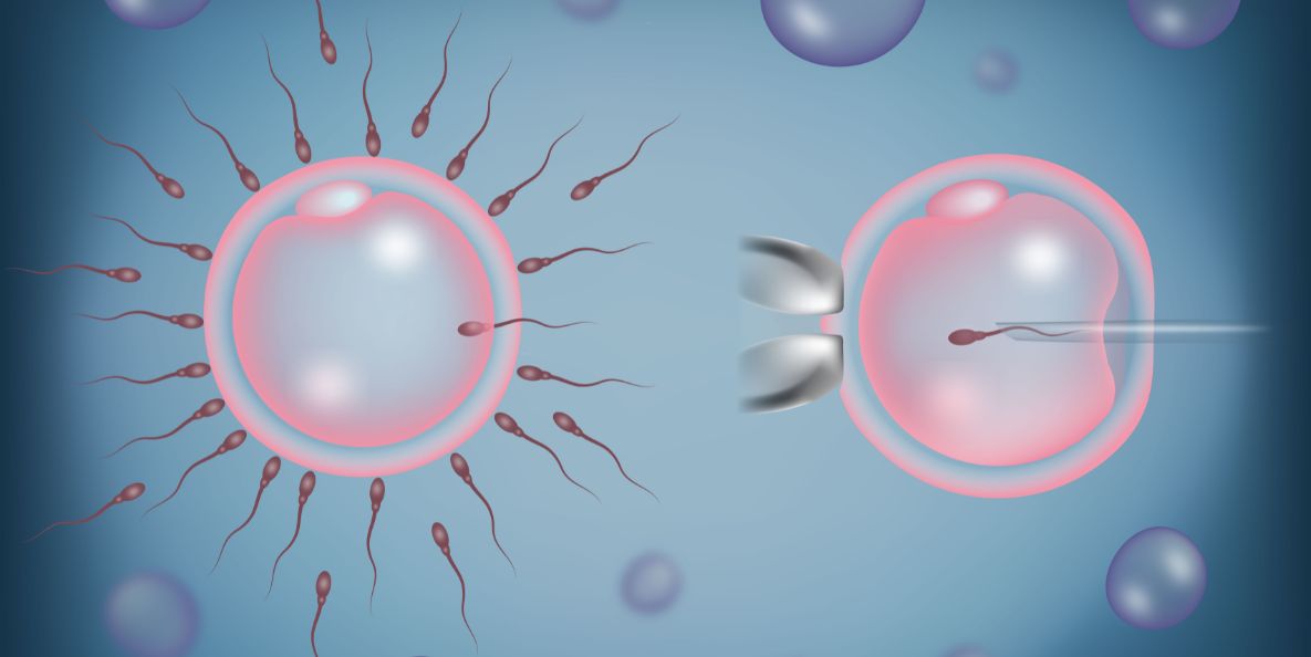 Intra Cytoplasmic Sperm Injection Treatment in Noida